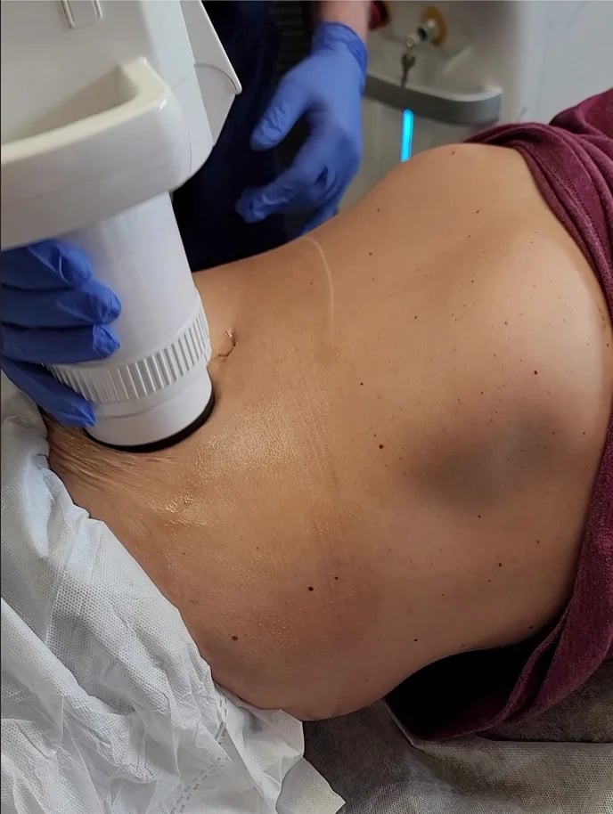 Healthcare provider in blue gloves performing ultrasound scan on patients back
